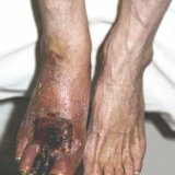 Оперативное лечение гангрены ноги