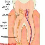 Современные методы лечения периодонтита