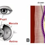 Восстановится ли зрение после кровоизлияния в сетчатку глаза