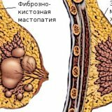 Мастопатия доброкачественное заболевание молочной железы