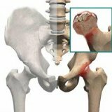 Лечение асептического некроза у человека