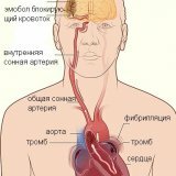 К каким осложнениям может привести сердечная аритмия
