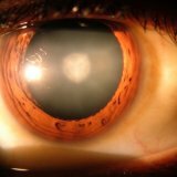 Народные методы лечения катаракты