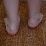 Лечение вальгусной деформации стопы у детей