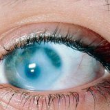 Заболевание человека закрытоугольная глаукома
