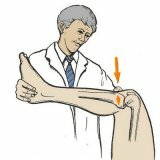Повреждения крестообразных связок колена