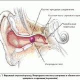Инородное тело в наружном слуховом проходе