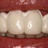 Восстановление зубной эмали в домашних условиях