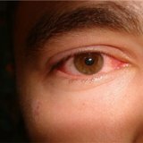 Воспалительное заболевание глазного яблока иридоциклит