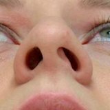 Искривление перегородки носа у детей