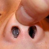 Доброкачественные опухоли носа у детей
