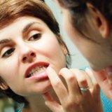 Почему при чистке зубов кровоточат десны