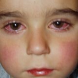 Глазные болезни лечение хронического коньюктивита