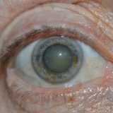 Причины лечение профилактика катаракты